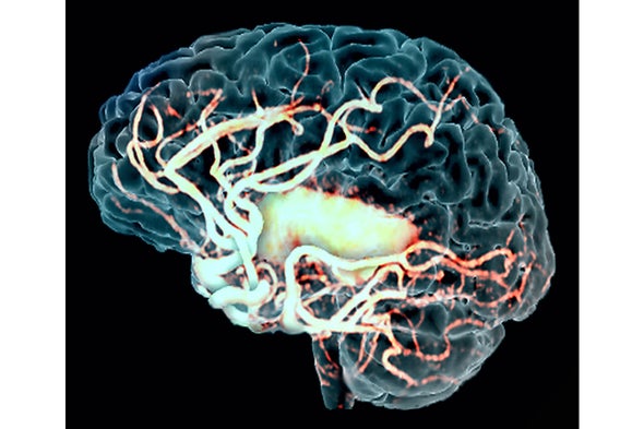 Gene in Infamous Experiment on Embryos Points to New Stroke Treatment 