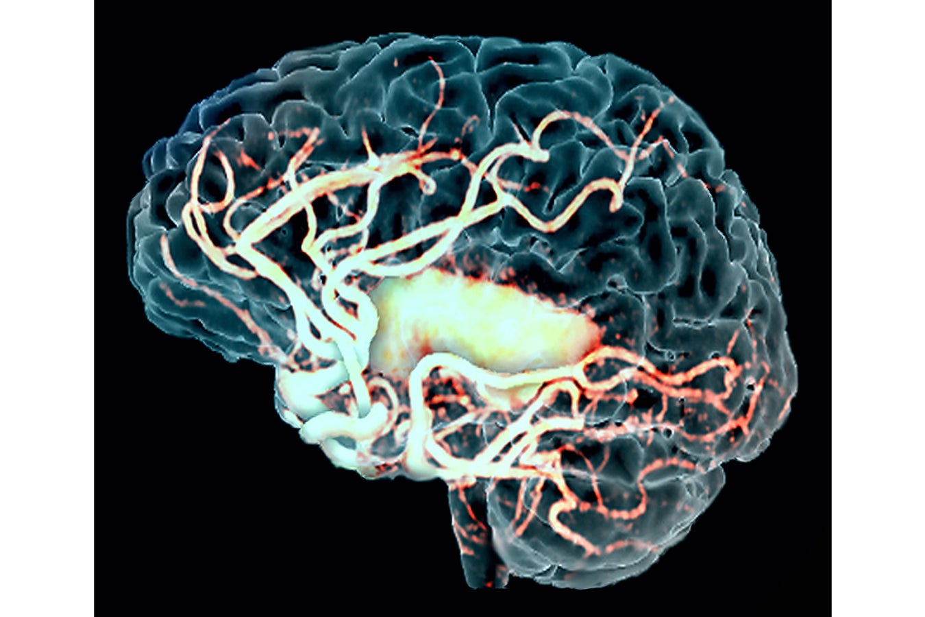Видео сосудов головного мозга. Поражение головного мозга. Поражение сосудов головного мозга.