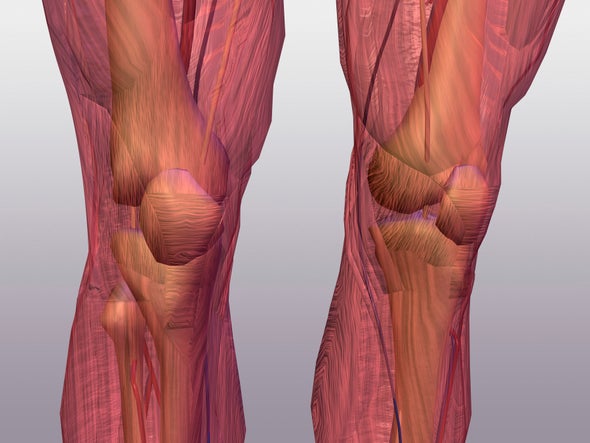 Knee Sounds Give Docs a Leg Up
