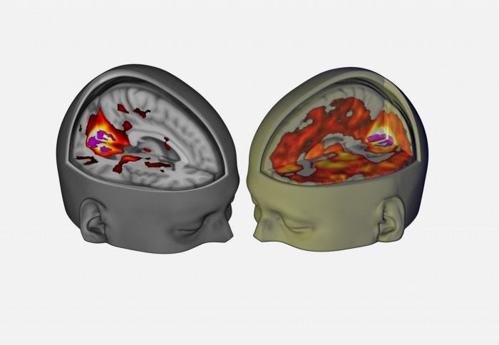 Lsd May Chip Away At The Brain S Sense Of Self Network Scientific American