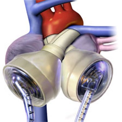 A Change of Heart: Portable Power Source Lets Cardiac Patients Await a Permanent Donor at Home