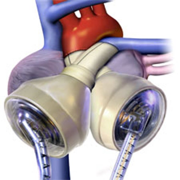 A Change of Heart: Portable Power Source Lets Cardiac Patients Await a Permanent Donor at Home