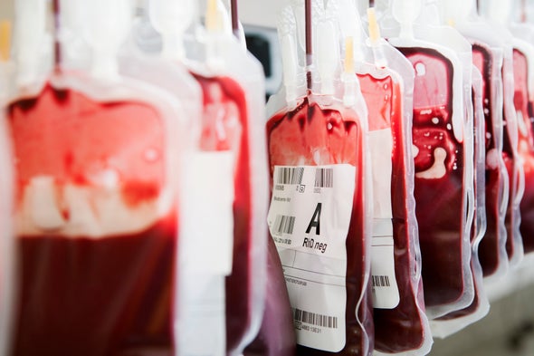 Infusions of Young Blood Tested in Patients with Dementia