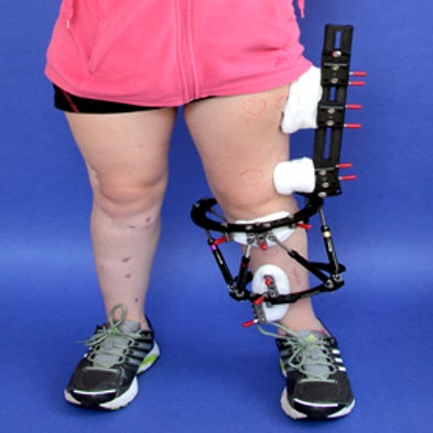 New Limb-Lengthening Tech May Reduce Complications for Sufferers of Crippling Deformities [Slide Show]