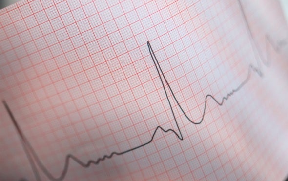 Radiation Might Help Heart Regain Its Rhythm