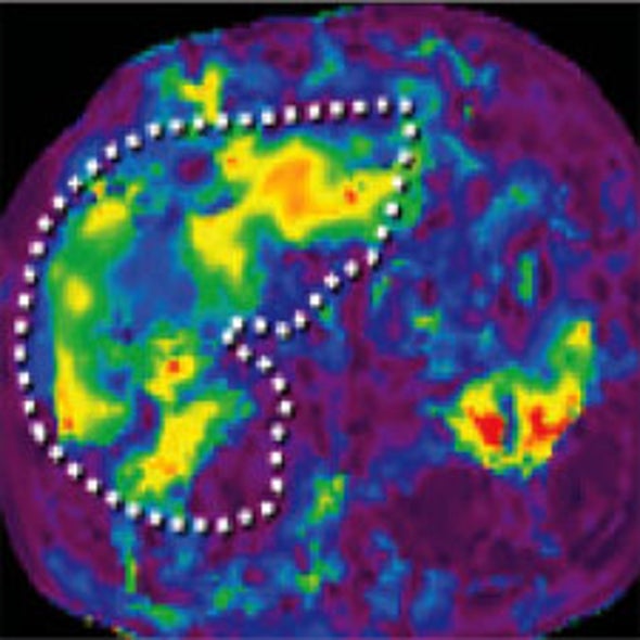 Vibrating Technology Promises to Replace Biopsies in Diagnosing Diseased Tissue