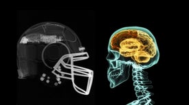 Helmet Sensors Reveal the Real Impact of Head Injuries