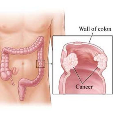 many colonoscopies for seniors carry unnecessary risks scientific
