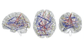 Brain Scans May Forecast Autism In High >> Stories By Nicholette Zeliadt Scientific American Brain Scans May Forecast Autism In High >> Stories By Nicholette Zeliadt Scientific American