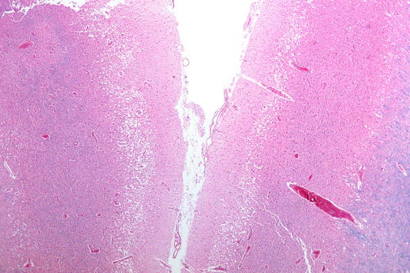 A Hidden Factor in Stroke Severity: The Microbes in Your Gut