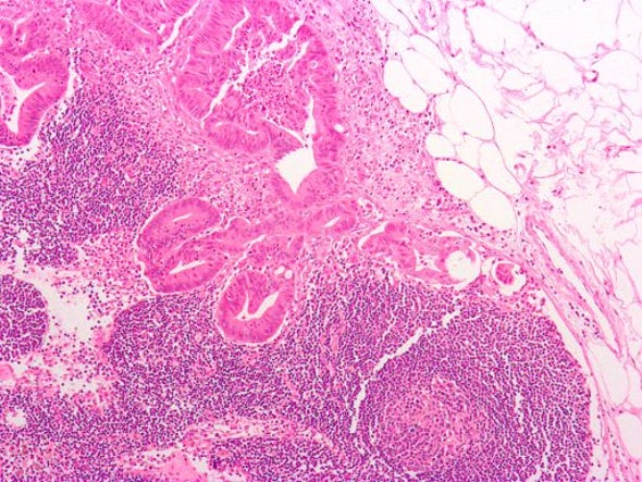Study: Genetic Tests of Tumors Often Give False Results