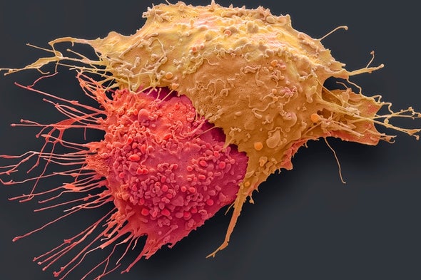 We Must Find Ways to Detect Cancer Much Earlier