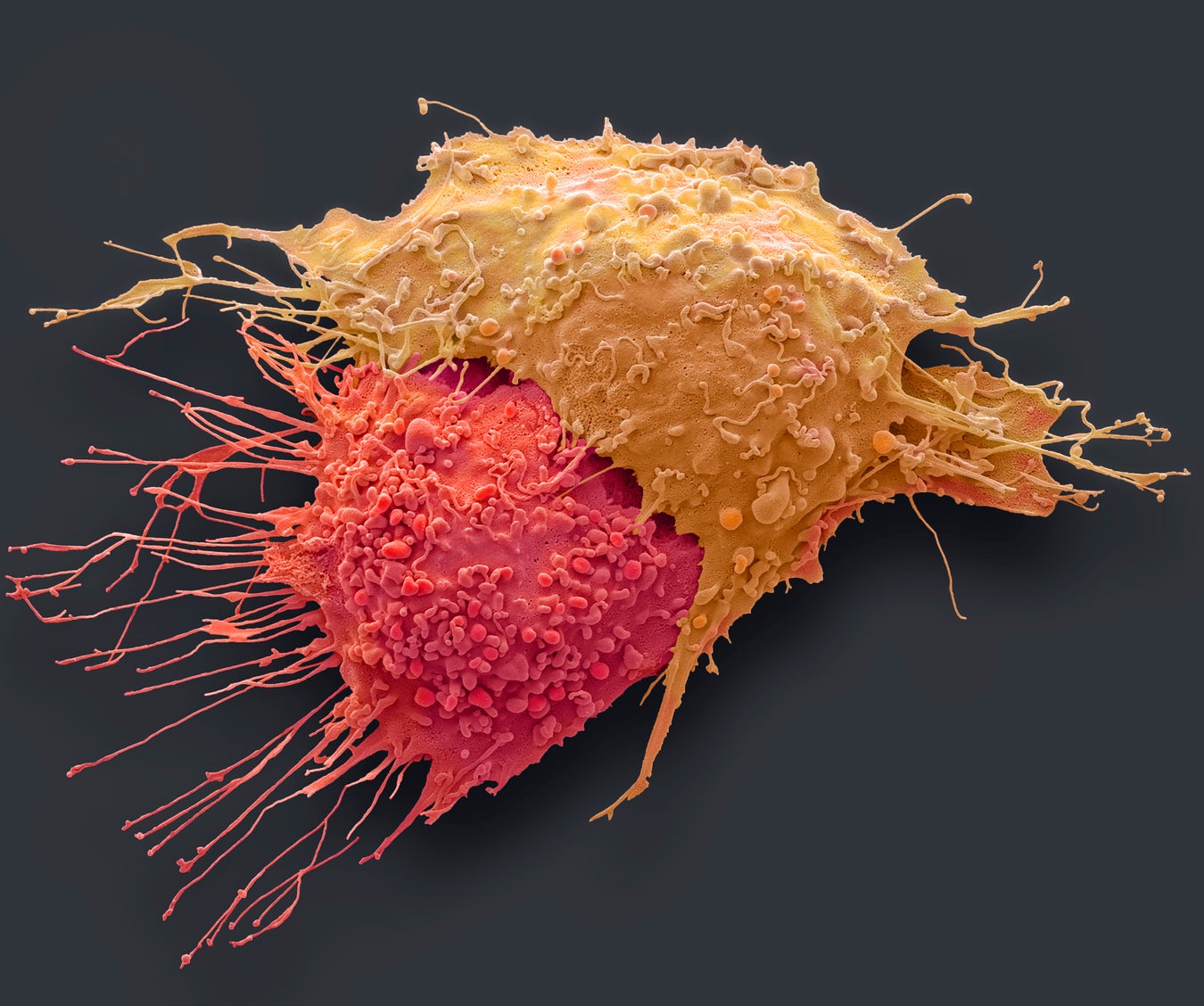 We Must Find Ways to Detect Cancer Much Earlier | Scientific American