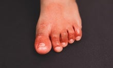 Are 'COVID Toes' Actually Caused by the Coronavirus?