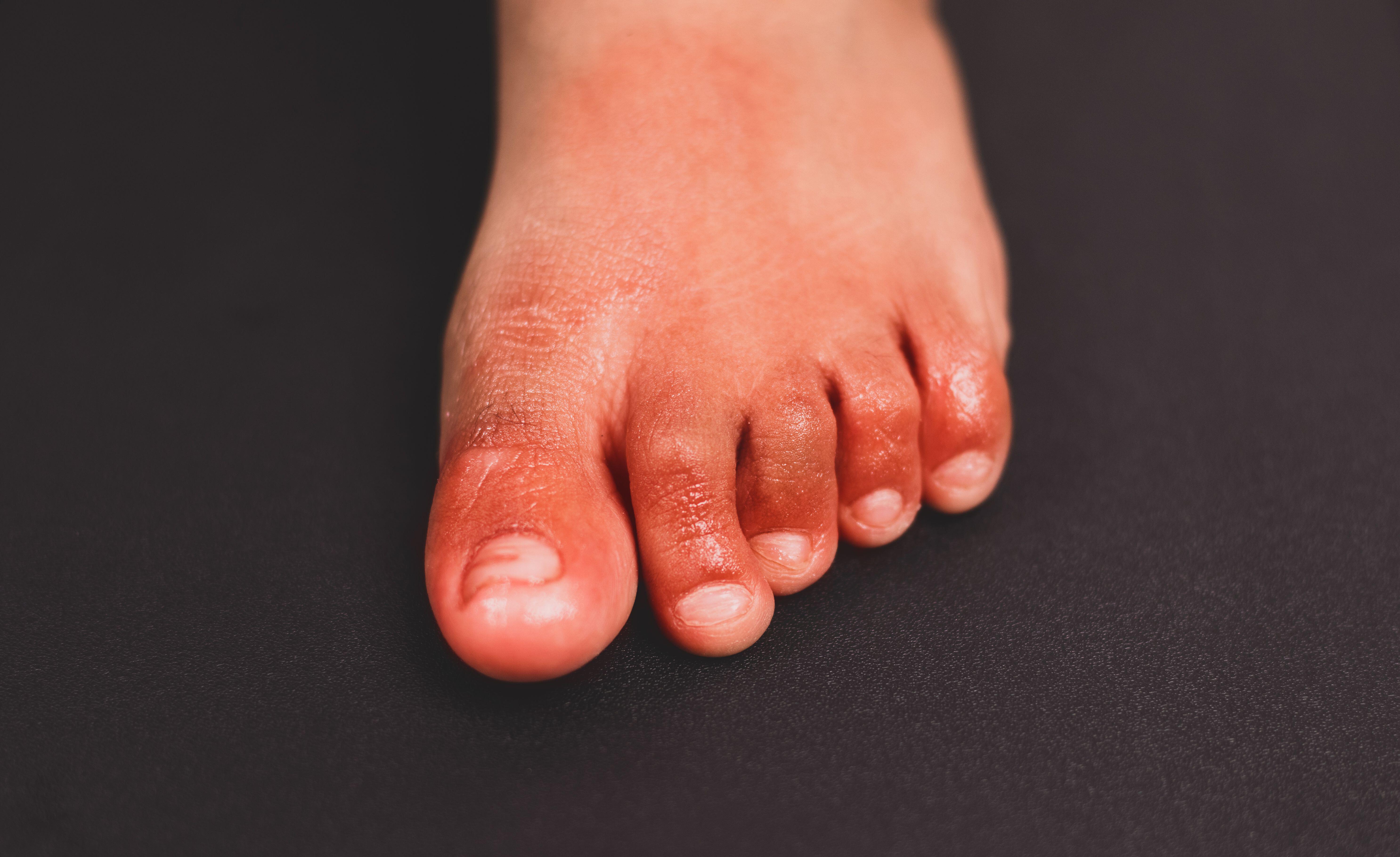 COVID Toes - How This Surprising COVID-19 Symptom Can Impact Skin