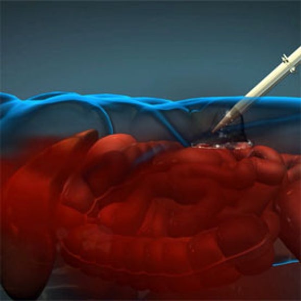 Injectable Foam Blocks Internal Bleeding on the Battlefield