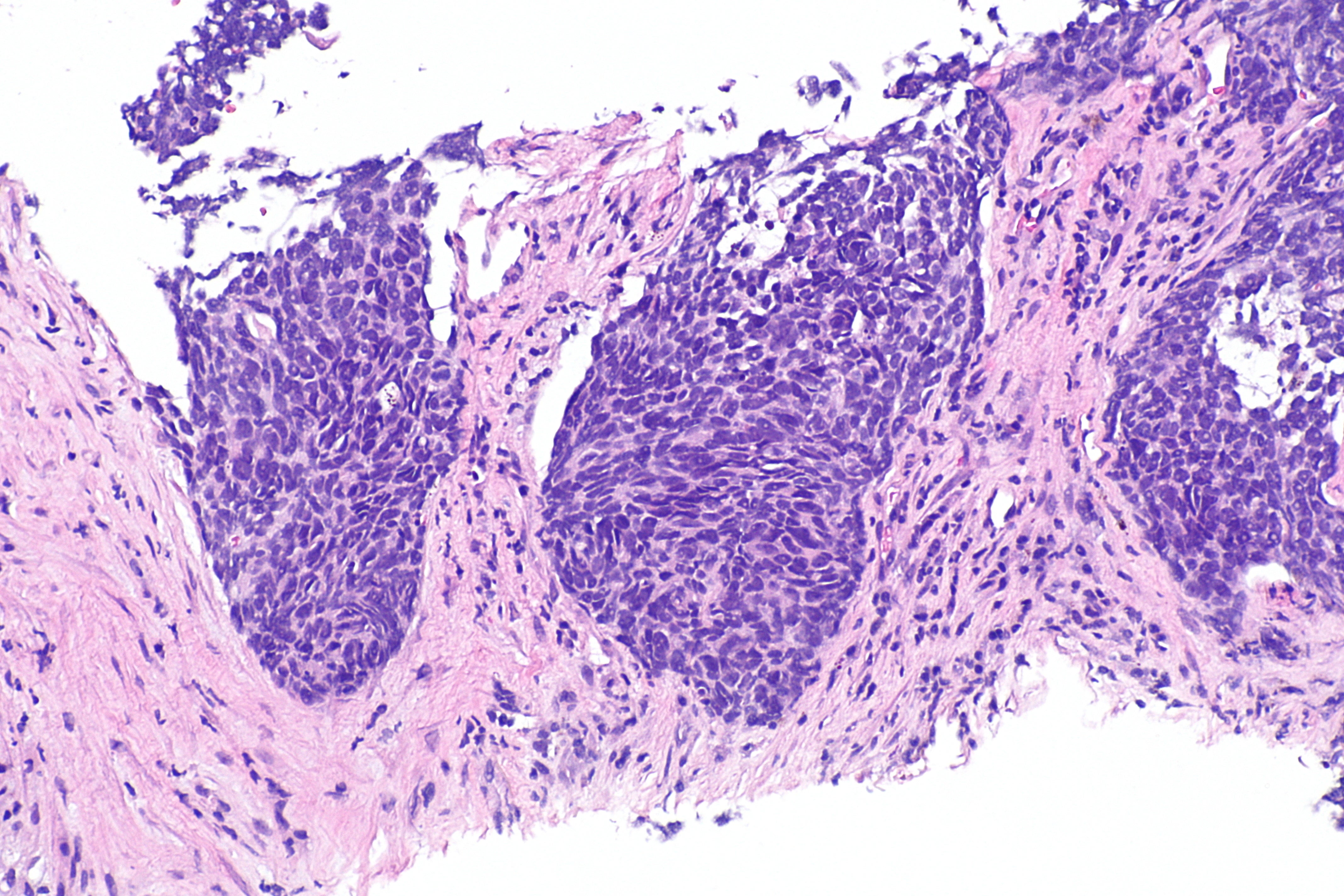 lung-most-cancers-capsule-halves-threat-of-dying-in-some-individuals