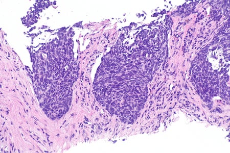 Non-small cell lung cancer