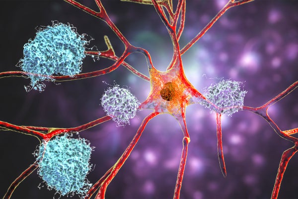 Illustration of amyloid plaques amongst neurons and neurofibrillary tangles inside neurons.
