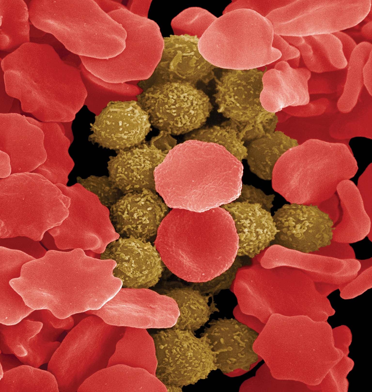 Red and white blood cells from a leukemia patient.