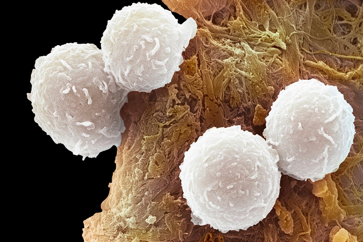 FDA Approves Second CAR-T Treatment For Cancer | Scientific American