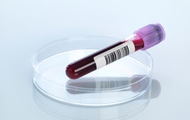 Detecting Alzheimer's Gets Easier with a Simple Blood Test