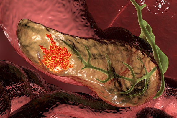 Computer illustration showing a malignant (cancerous) growth (red) in the pancreas (yellow)