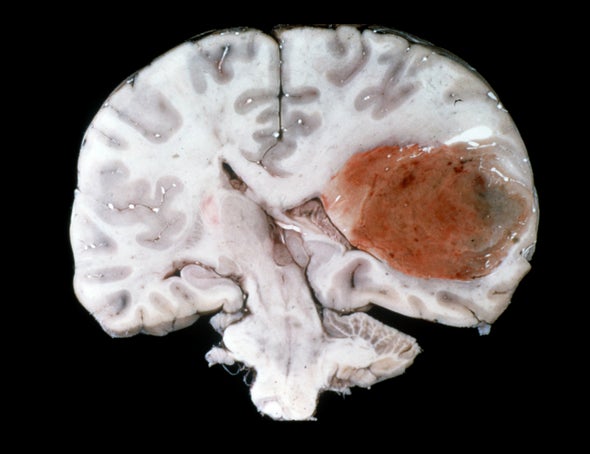 brain tumor pictures