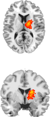Brain Scans Show Promise for Early Detection of Cognitive Problems
