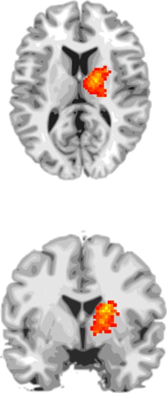 Brain Scans Show Promise for Early Detection of Cognitive Problems