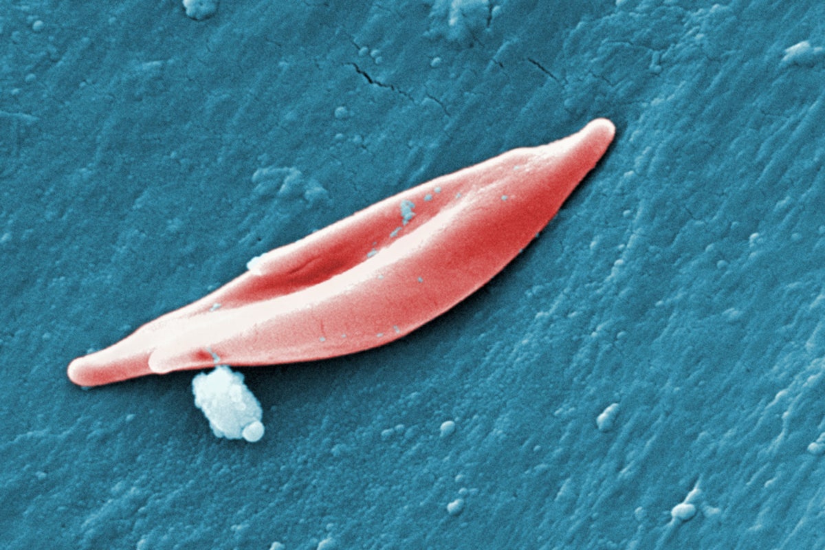 FDA Approves First Sickle Cell Drug in 20 Years