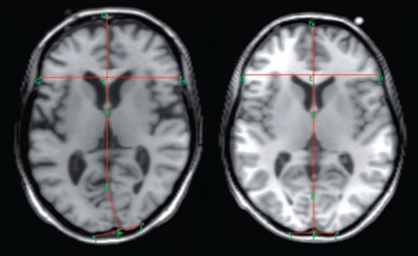 Warped Brain Lobes Could Underlie Depression Symptoms