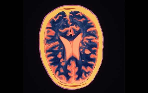 Gut Germs Appear to Play Role in Multiple Sclerosis