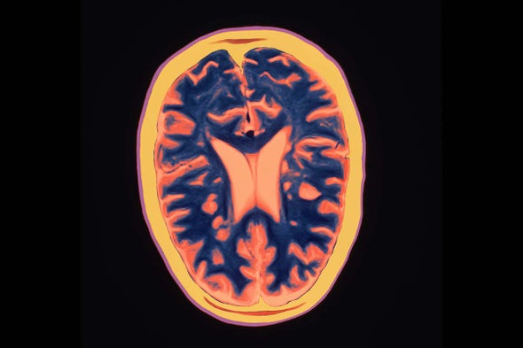 Gut Germs Appear to Play Role in Multiple Sclerosis