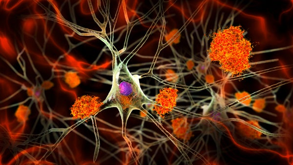 Illustration of amyloid plaques amongst neurons and neurofibrillary tangles inside neurons.