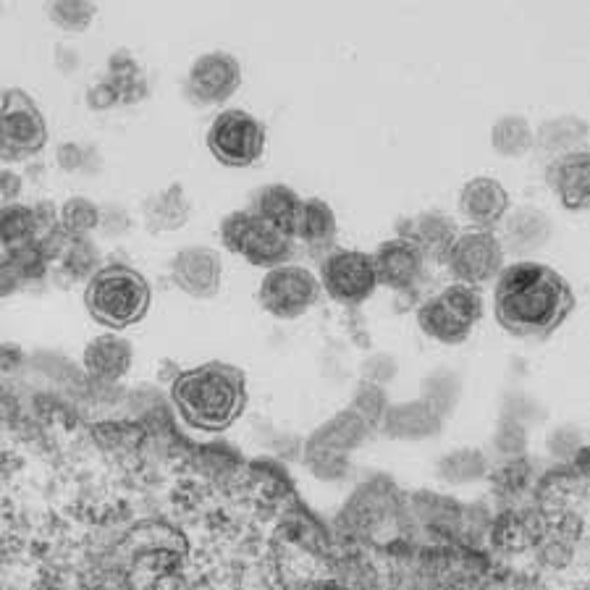 Retrovirus Linked to Chronic Fatigue Syndrome, Could Aid in Diagnosis