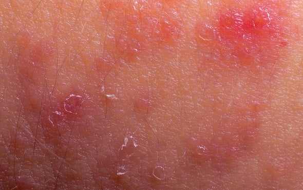 Bacteria Might Share the Blame for Eczema