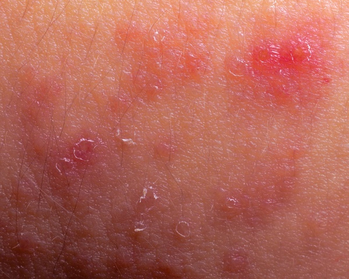 Bacteria Might Share the Blame for Eczema