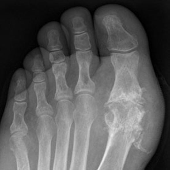 Gout on the Rise as Americans Gain Weight
