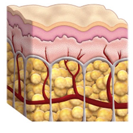 cellulite skin cross section illutration diagrom