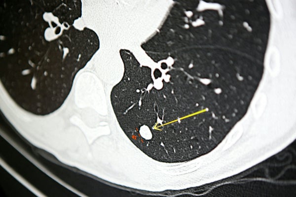 Scan pointing out nodule in lung.