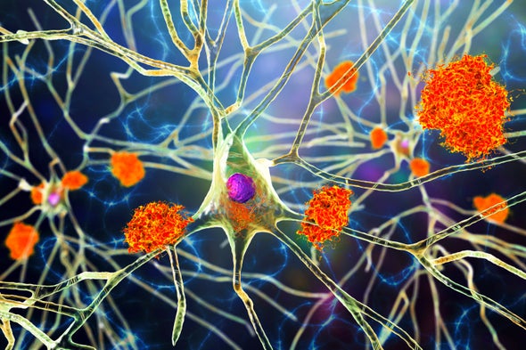 This Is How an Alzheimer's Gene Ravages the Brain