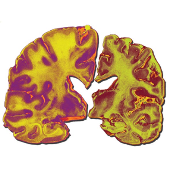 Brain Changes Decades before Dementia Sets In