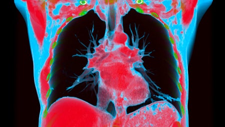 CT Scan of Human heart