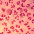 New Treatment for Gonorrhea Prevents Reinfection