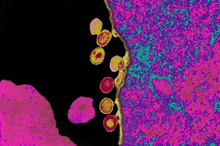 Color enhanced transmission electron micrograph (TEM) of an HIV virus budding out of an infected T-lymphocyte cell