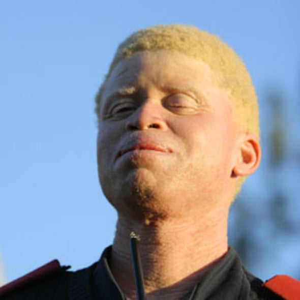 albino black person