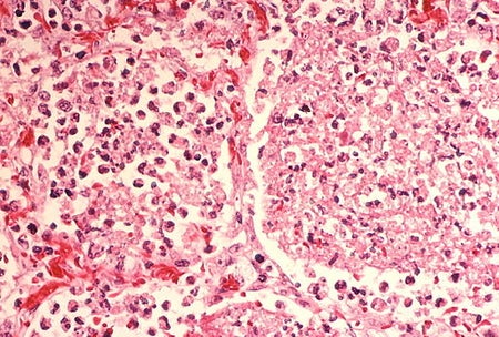 legionella