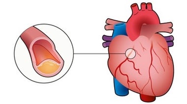 A Graphical Guide to Ischemic Heart Disease