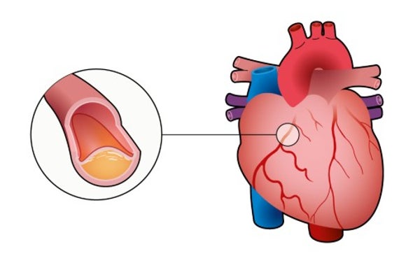 راهنمای گرافیکی بیماری ایسکمیک قلب